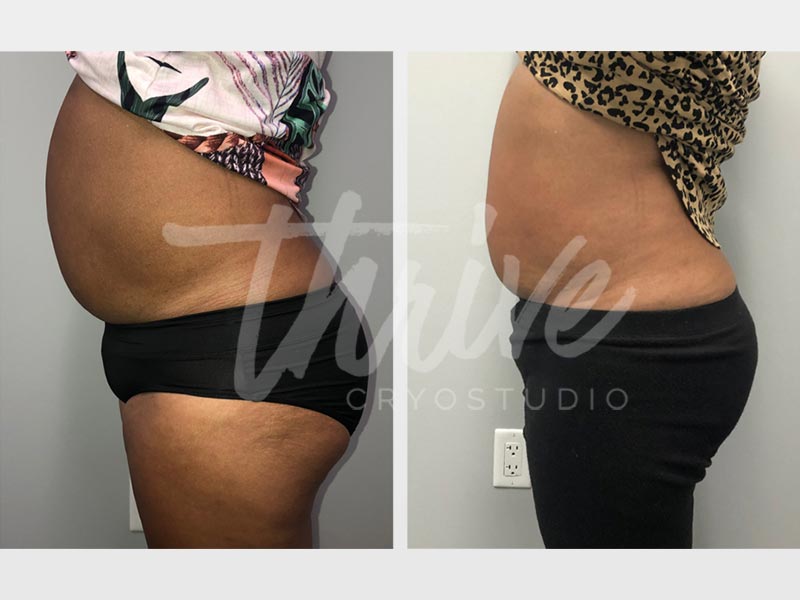 Thrive CryoStudio - Before and After