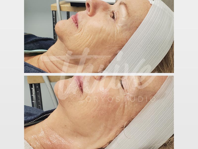 Thrive CryoStudio - Before and After