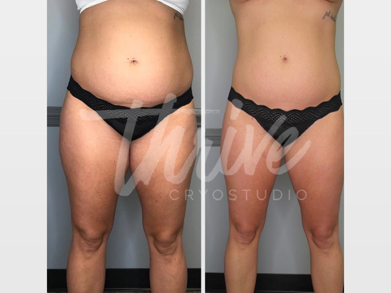Thrive CryoStudio - Before and After